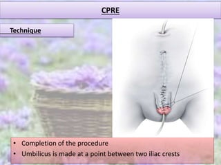 CPRE
• Completion of the procedure
• Umbilicus is made at a point between two iliac crests
Technique
 