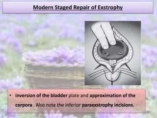 Modern Staged Repair of Exstrophy
• Inversion of the bladder plate and approximation of the
corpora . Also note the inferior paraexstrophy incisions.
 
