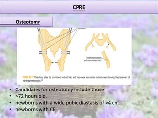 CPRE
Osteotomy
• Candidates for osteotomy include those
• >72 hours old,
• newborns with a wide pubic diastasis of >4 cm,
• newborns with CE
 