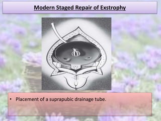 Modern Staged Repair of Exstrophy
• Placement of a suprapubic drainage tube.
 