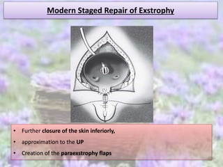 Modern Staged Repair of Exstrophy
• Further closure of the skin inferiorly,
• approximation to the UP
• Creation of the paraexstrophy flaps
 