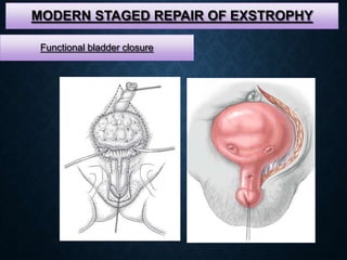 MODERN STAGED REPAIR OF EXSTROPHY
Functional bladder closure
 