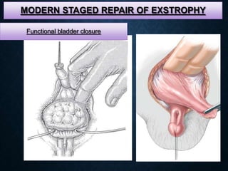 MODERN STAGED REPAIR OF EXSTROPHY
Functional bladder closure
 