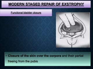 MODERN STAGED REPAIR OF EXSTROPHY
• Closure of the skin over the corpora and their partial
freeing from the pubis
Functional bladder closure
 