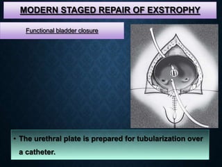 MODERN STAGED REPAIR OF EXSTROPHY
• The urethral plate is prepared for tubularization over
a catheter.
Functional bladder closure
 
