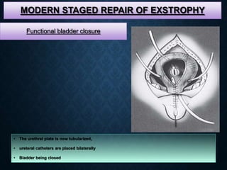 MODERN STAGED REPAIR OF EXSTROPHY
• The urethral plate is now tubularized,
• ureteral catheters are placed bilaterally
• Bladder being closed
Functional bladder closure
 