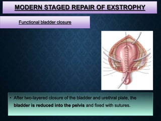 MODERN STAGED REPAIR OF EXSTROPHY
• After two-layered closure of the bladder and urethral plate, the
bladder is reduced into the pelvis and fixed with sutures.
Functional bladder closure
 