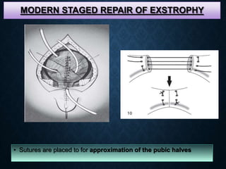 MODERN STAGED REPAIR OF EXSTROPHY
• Sutures are placed to for approximation of the pubic halves
 