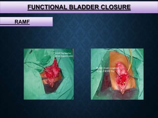FUNCTIONAL BLADDER CLOSURE
RAMF
 