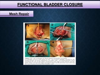 FUNCTIONAL BLADDER CLOSURE
Mesh Repair
 