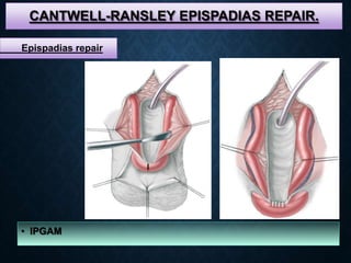 CANTWELL-RANSLEY EPISPADIAS REPAIR.
• IPGAM
Epispadias repair
 