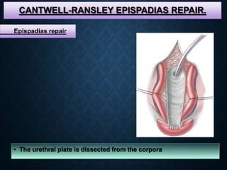 CANTWELL-RANSLEY EPISPADIAS REPAIR.
• The urethral plate is dissected from the corpora
Epispadias repair
 
