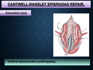 CANTWELL-RANSLEY EPISPADIAS REPAIR.
• Urethral reconstruction (urethroplasty)
Epispadias repair
 