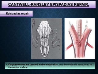 CANTWELL-RANSLEY EPISPADIAS REPAIR.
• Corporotomies are created at the midphallus, and the urethra is transposed to
the ventral surface.
Epispadias repair
 