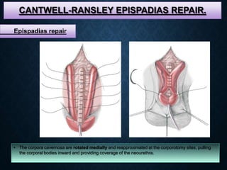 CANTWELL-RANSLEY EPISPADIAS REPAIR.
• The corpora cavernosa are rotated medially and reapproximated at the corporotomy sites, pulling
the corporal bodies inward and providing coverage of the neourethra.
Epispadias repair
 