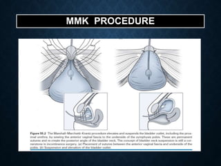 MMK PROCEDURE
 