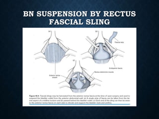 BN SUSPENSION BY RECTUS
FASCIAL SLING
 