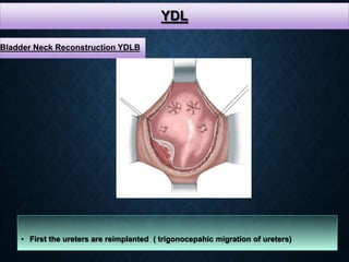 YDL
• First the ureters are reimplanted ( trigonocepahic migration of ureters)
Bladder Neck Reconstruction YDLB
 