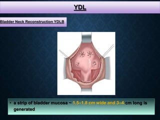 YDL
• a strip of bladder mucosa ~ 1.5–1.8 cm wide and 3–4 cm long is
generated
Bladder Neck Reconstruction YDLB
 