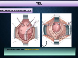 YDL
• A tube is formed over 8 French catheter
Bladder Neck Reconstruction YDLB
 