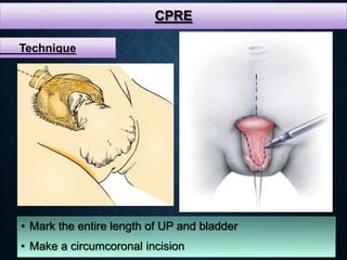 CPRE
• Mark the entire length of UP and bladder
• Make a circumcoronal incision
Technique
 