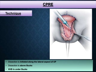 CPRE
• Dissection is initiated along the lateral aspect of UP
• Dissection is above Bucks
• NVB is under Bucks
Technique
 
