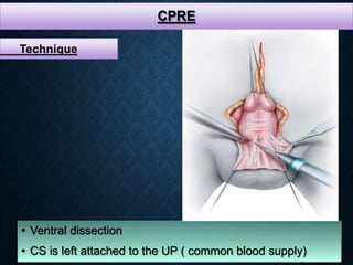 CPRE
• Ventral dissection
• CS is left attached to the UP ( common blood supply)
Technique
 