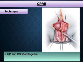 CPRE
• UP and CS lifted together
Technique
 