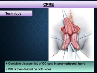 CPRE
• Complete disassembly of CC upto intersymphyseal band
• ISB is then divided on both sides
Technique
 