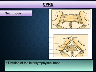 CPRE
• Division of the intersymphyseal band
Technique
 