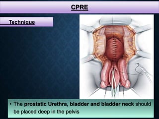 CPRE
• The prostatic Urethra, bladder and bladder neck should
be placed deep in the pelvis
Technique
 