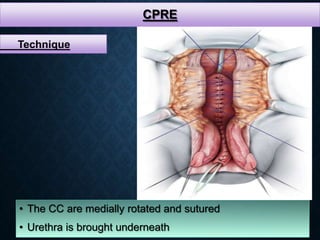 CPRE
• The CC are medially rotated and sutured
• Urethra is brought underneath
Technique
 
