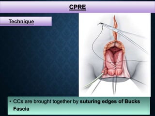 CPRE
• CCs are brought together by suturing edges of Bucks
Fascia
Technique
 
