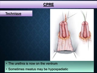 CPRE
• The urethra is now on the ventrum
• Sometimes meatus may be hypospadiatic
Technique
 
