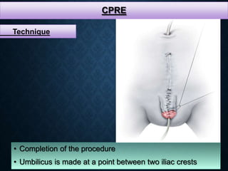 CPRE
• Completion of the procedure
• Umbilicus is made at a point between two iliac crests
Technique
 