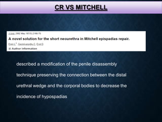 CR VS MITCHELL
described a modification of the penile disassembly
technique preserving the connection between the distal
urethral wedge and the corporal bodies to decrease the
incidence of hypospadias
 