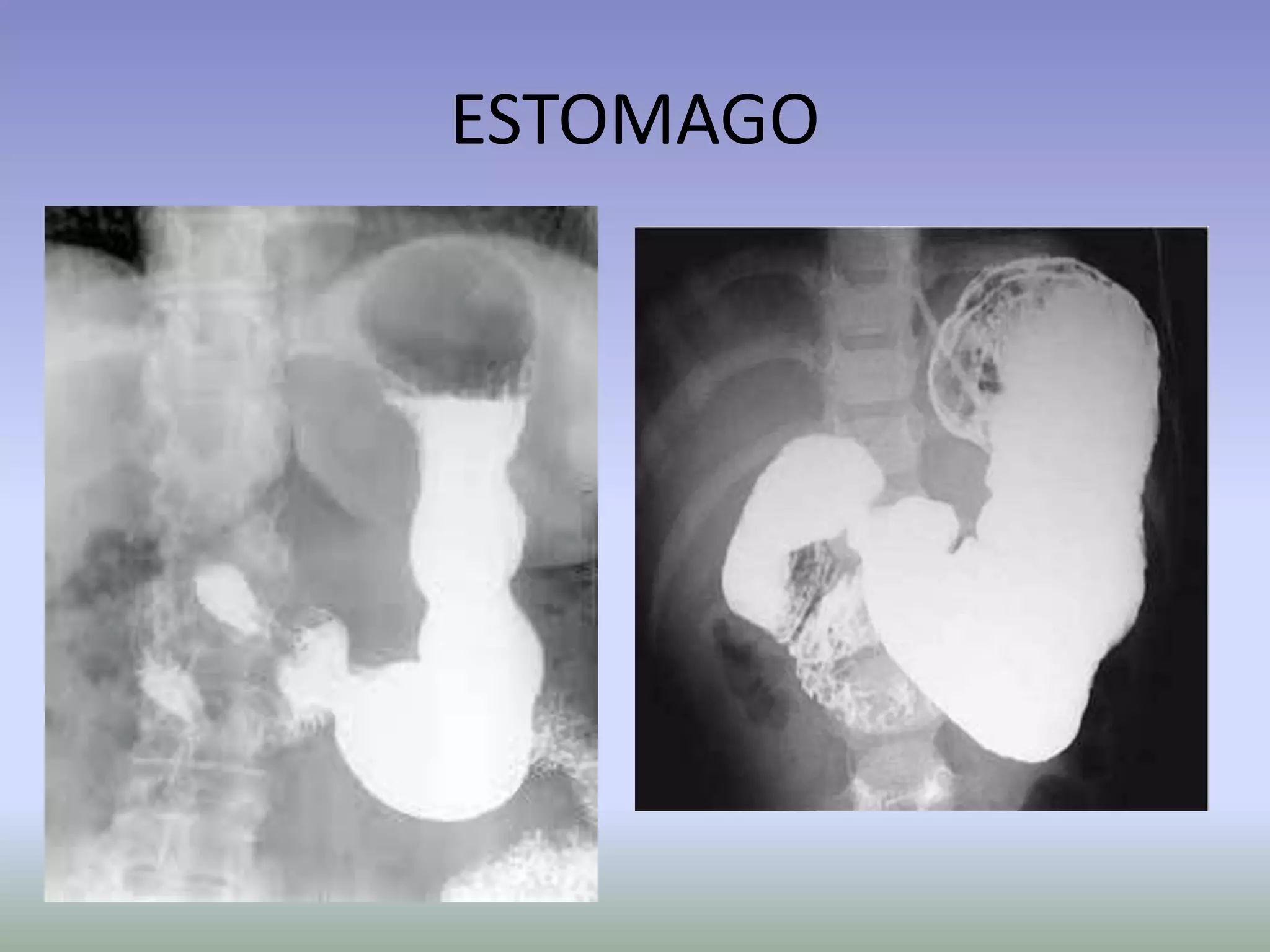 Eed Normal EED - Seriografia do Esôfago Estomago e Duodeno | PPTX