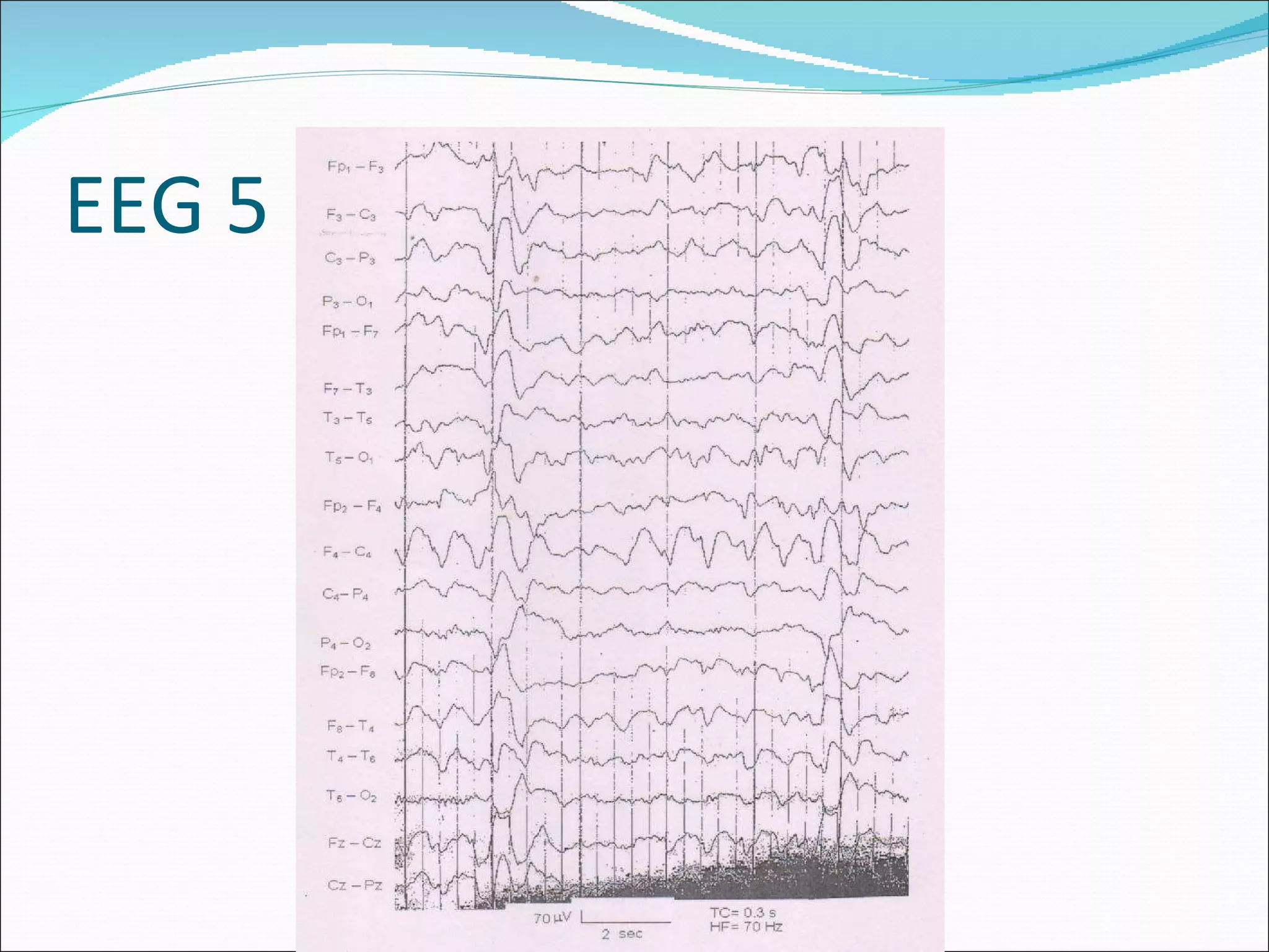 EEG: Basics | PPT