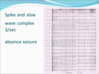 EEG: Basics | PPT