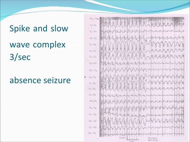 EEG: Basics | PPT