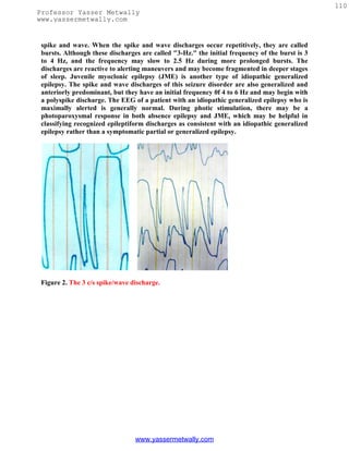 110
Professor Yasser Metwally
www.yassermetwally.com


 spike and wave. When the spike and wave discharges occur repetitively, they are called
 bursts. Although these discharges are called "3-Hz." the initial frequency of the burst is 3
 to 4 Hz, and the frequency may slow to 2.5 Hz during more prolonged bursts. The
 discharges are reactive to alerting maneuvers and may become fragmented in deeper stages
 of sleep. Juvenile myoclonic epilepsy (JME) is another type of idiopathic generalized
 epilepsy. The spike and wave discharges of this seizure disorder are also generalized and
 anteriorly predominant, but they have an initial frequency 0f 4 to 6 Hz and may begin with
 a polyspike discharge. The EEG of a patient with an idiopathic generalized epilepsy who is
 maximally alerted is generally normal. During photic stimulation, there may be a
 photoparoxysmal response in both absence epilepsy and JME, which may be helpful in
 classifying recognized epileptiform discharges as consistent with an idiopathic generalized
 epilepsy rather than a symptomatic partial or generalized epilepsy.




 Figure 2. The 3 c/s spike/wave discharge.




                                 www.yassermetwally.com
 
