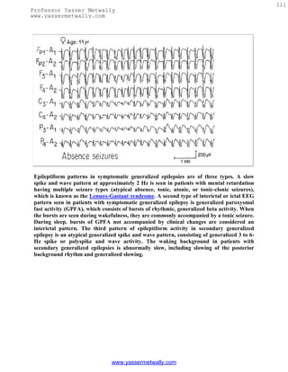 111
Professor Yasser Metwally
www.yassermetwally.com




 Epileptiform patterns in symptomatic generalized epilepsies are of three types. A slow
 spike and wave pattern at approximately 2 Hz is seen in patients with mental retardation
 having multiple seizure types (atypical absence, tonic, atonic, or tonic-clonic seizures),
 which is known as the Lennox-Gastaut syndrome. A second type of interictal or ictal EEG
 pattern seen in patients with symptomatic generalized epilepsy is generalized paroxysmal
 fast activity (GPFA), which consists of bursts of rhythmic, generalized beta activity. When
 the bursts are seen during wakefulness, they are commonly accompanied by a tonic seizure.
 During sleep. bursts of GPFA not accompanied by clinical changes are considered an
 interictal pattern. The third pattern of epileptiform activity in secondary generalized
 epilepsy is an atypical generalized spike and wave pattern, consisting of generalized 3 to 6-
 Hz spike or polyspike and wave activity. The waking background in patients with
 secondary generalized epilepsies is abnormally slow, including slowing of the posterior
 background rhythm and generalized slowing.




                                 www.yassermetwally.com
 