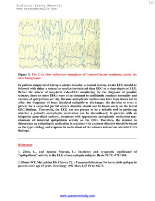 112
Professor Yasser Metwally
www.yassermetwally.com




 Figure 3. The 2 c/s slow spike/wave complexes of Lennox-Gastaut syndrome, notice the
 slow background.

 In patients suspected of having a seizure disorder, a normal routine, awake EEG should be
 followed with either a natural or medication-induced sleep EEG or a sleep-deprived EEG.
 Before the advent of long-term video-EEG monitoring for the diagnosis of possible
 seizures, three or more EEGs were often obtained to confidently conclude normality and
 absence of epileptiform activity. Because antiepileptic medications have been shown not to
 affect the frequency of focal interictal epileptiform discharges, the decision to treat a
 patient for a suspected partial seizure disorder should not be based solely on the initial
 EEG findings. Conversely, the EEG has not proven to be a reliable tool in predicting
 whether a patient's antiepileptic medication can be discontinued. In patients with an
 idiopathic generalized epilepsy, treatment with appropriate antiepileptic medication may
 eliminate all interictal epileptiform activity on the EEG. Therefore, the decision to
 discontinue an antiepileptic medication in a patient with a seizure disorder should be based
 on the type, etiology and response to medications of the seizures and not on interictal EEG
 findings.



 References

 1. Zivin, L., and Ajmone Marsan, C.: Incidence and prognostic significance of
 "epileptiform" activity in the EEG of non-epileptic subjects. Brain 91:751-778 1968.

 2. Blume WT, McLachlan RS, Chovaz CJ, : Temporal lobectomy for intractable epilepsy in
 patients over age 45 years. Neurology 1992 Mar; 42(3 Pt 1): 662-5.




                                 www.yassermetwally.com
 
