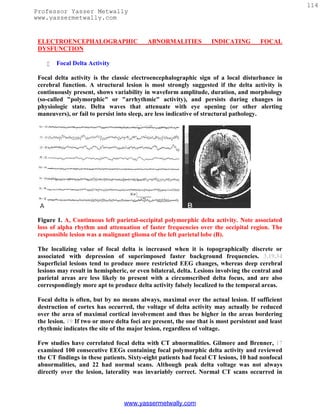 114
Professor Yasser Metwally
www.yassermetwally.com


 ELECTROENCEPHALOGRAPHIC                   ABNORMALITIES            INDICATING         FOCAL
 DYSFUNCTION

       Focal Delta Activity

 Focal delta activity is the classic electroencephalographic sign of a local disturbance in
 cerebral function. A structural lesion is most strongly suggested if the delta activity is
 continuously present, shows variability in waveform amplitude, duration, and morphology
 (so-called "polymorphic" or "arrhythmic" activity), and persists during changes in
 physiologic state. Delta waves that attenuate with eye opening (or other alerting
 maneuvers), or fail to persist into sleep, are less indicative of structural pathology.




 Figure 1. A, Continuous left parietal-occipital polymorphic delta activity. Note associated
 loss of alpha rhythm and attenuation of faster frequencies over the occipital region. The
 responsible lesion was a malignant glioma of the left parietal lobe (B).

 The localizing value of focal delta is increased when it is topographically discrete or
 associated with depression of superimposed faster background frequencies. 3,19,34
 Superficial lesions tend to produce more restricted EEG changes, whereas deep cerebral
 lesions may result in hemispheric, or even bilateral, delta. Lesions involving the central and
 parietal areas are less likely to present with a circumscribed delta focus, and are also
 correspondingly more apt to produce delta activity falsely localized to the temporal areas.

 Focal delta is often, but by no means always, maximal over the actual lesion. If sufficient
 destruction of cortex has occurred, the voltage of delta activity may actually be reduced
 over the area of maximal cortical involvement and thus be higher in the areas bordering
 the lesion. 19 If two or more delta foci are present, the one that is most persistent and least
 rhythmic indicates the site of the major lesion, regardless of voltage.

 Few studies have correlated focal delta with CT abnormalities. Gilmore and Brenner, 17
 examined 100 consecutive EEGs containing focal polymorphic delta activity and reviewed
 the CT findings in these patients. Sixty-eight patients had focal CT lesions, 10 had nonfocal
 abnormalities, and 22 had normal scans. Although peak delta voltage was not always
 directly over the lesion, laterality was invariably correct. Normal CT scans occurred in




                                  www.yassermetwally.com
 