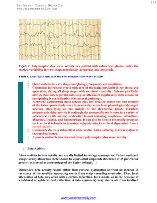 116
Professor Yasser Metwally
www.yassermetwally.com




 Figure 2. Polymorphic slow wave activity in a patient with subcortical glioma, notice the
 marked variability in wave shape morphology, frequency and amplitude.

 Table 1. Electrical criteria of the Polymorphic slow wave activity.

           Quite variable in wave shape morphology, frequency and amplitude.
           Commonly lateralized over a wide area of the scalp, persistent in eye closed, eye
            open state, during all sleep stages, with no visual reactivity. Polymorphic Delta
            activity that fails to persist into sleep or attenuates significantly with arousal or
            eye opening is less indicative of structural pathology.
           Persistent polymorphic delta activity may not precisely match the true location
            of the lesion, particularly since it presumably arises from physiological deranged
            neurons often lying on the margin of the destructive lesion. Persistent
            polymorphic delta activity is aetiologically nonspecific and is seen in a variety of
            subcortical (while matter) destructive lesions including neoplasms, infarctions,
            abscesses, trauma, and haemorrhage. It can also be seen in reversible processes
            such as focal ischemia in transient ischemic attacks or focal depression from a
            recent seizure.
           Commonly due to a subcortical white matter lesion inducing deafferentation of
            the cerebral cortex.
           A purely cortical lesion does not induce polymorphic slow wave activity.


       Beta Activity

 Abnormalities in beta activity are usually limited to voltage asymmetries. To be considered
 unequivocally abnormal, there should be a persistent amplitude difference of 35 per cent or
 greater (expressed as a percentage of the higher voltage). 32

 Diminished beta activity results either from cortical dysfunction or from an increase in
 resistance of the medium separating cortex from scalp recording electrodes. Thus, local
 attenuation of beta may occur with a cortical infarction, for example, or in the presence of
 a subdural or epidural fluid collection. A beta asymmetry may also result from localized




                                  www.yassermetwally.com
 