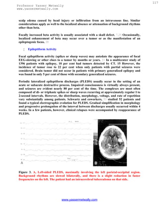 117
Professor Yasser Metwally
www.yassermetwally.com


 scalp edema caused by head injury or infiltration from an intravenous line. Similar
 considerations apply as well to the localized absence or attenuation of background rhythms
 other than beta.

 Focally increased beta activity is usually associated with a skull defect. 7,25 Occasionally,
 localized enhancement of beta may occur over a tumor or as the manifestation of an
 epileptogenic focus. 20

       Epileptiform Activity

 Focal epileptiform activity (spikes or sharp waves) may antedate the appearance of focal
 EEG-slowing or other clues to a tumor by months or years. 21 In a multicenter study of
 1396 patients with epilepsy, 10 per cent had tumors detected by CT. 15 However, the
 incidence of tumor rose to 22 per cent when only patients with partial seizures were
 considered. Brain tumor did not occur in patients with primary generalized epilepsy and
 was found in only 5 per cent of those with secondary generalized seizures.

 Periodic lateralized epileptiform discharges (PLEDS) usually occur in the setting of an
 acute or subacute destructive process. Impaired consciousness is virtually always present,
 and seizures are evident nearly 80 per cent of the time. The complexes are most often
 composed of di- or triphasic spikes or sharp waves recurring at approximately regular I to
 2-second intervals. However, the distribution, morphology, voltage, and rate of repetition
 vary substantially among patients. Schwartz and coworkers, 53 studied 52 patients and
 found a typical electrographic evolution for PLEDS. Gradual simplification in morphology
 and progressive prolongation of the interval between discharges usually occurred within 4
 weeks. In a few patients, however, clinical relapses were accompanied by reappearance of
 PLEDS.




 Figure 3. A, Left-sided PLEDS, maximally involving the left parietal-occipital region.
 Background rhythms are slowed bilaterally, and there is a slight reduction in faster
 frequencies on the left. The patient had an intracerebral tuberculoma on that side.




                                 www.yassermetwally.com
 