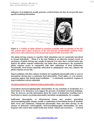 119
Professor Yasser Metwally
www.yassermetwally.com


 indicators of an ipsilateral, usually posterior, cerebral lesion, but they do not provide more
 specific localizing information.




 Figure 4. A, Failure of alpha rhythm to attenuate normally with eye-opening on the left.
 The patient had a giant aneurysm of the left internal carotid-middle cerebral artery
 bifurcation with compression of the frontal and temporal lobes from below (B).

 The photic driving response to repetitive flash stimulation may be consistently lateralized
 in normal individuals. 9 When it is the only finding in an otherwise normal record, an
 asymmetry of photic driving may usually be ignored. It is clear that a cortical lesion may
 depress the photic response unilaterally, but under these circumstances, the asymmetric
 photic response occurs in conjunction with other indications of focal dysfunction.
 Occasionally, focal lesions (especially subcortical or epileptogenic ones) may enhance the
 photic response on one side. 9

 Hyperventilation will often enhance localized, low-amplitude polymorphic delta or convert
 intermittent slowing into a continuous focal abnormality. Focal spikes, or even seizures,
 sometimes appear only during hyperventilation. 42 A consistently asymmetric response to
 hyperventilation is always abnormal.

 GENERALIZED ELECTROENCEPHALOGRAPHIC CHANGES

 Generalized electroencephalographic abnormalities do not contribute to localization of a
 focal lesion or by themselves even suggest the presence of localized structural pathology.
 They do, however, provide information about the extent of dysfunction resulting from a
 focal lesion or about a coexisting abnormality (metabolic encephalopathy, for example).

 Subfrontal, diencephalic, or infratentorial lesions may produce generalized
 electroencephalographic changes, usually a combination of intermittent bursts of rhythmic
 delta waves and continuous, widespread polymorphic theta and delta slowing. In the
 absence of obstructive hydrocephalus, electroencephalographic abnormalities are more
 frequent with rostral than caudal brain-stem lesions. Schaul and coworkers, 51 reviewed




                                  www.yassermetwally.com
 