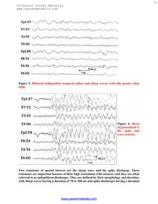 12
Professor Yasser Metwally
www.yassermetwally.com




 Figure 5. Bilateral independent temporal spikes and sharp waves. Left side greater than
 right.




                                                                            Figure 6. Burst
                                                                            of generalized 3-
                                                                            Hz spike and
                                                                            wave activity.




 Two transients of special interest are the sharp wave and the spike discharge. These
 transients are important because of their high correlation with seizures, and they are often
 referred to as epileptiform discharges. They are defined by their morphology and duration,
 with sharp waves having a duration of 70 to 200 ms and spike discharges having a duration




                                 www.yassermetwally.com
 