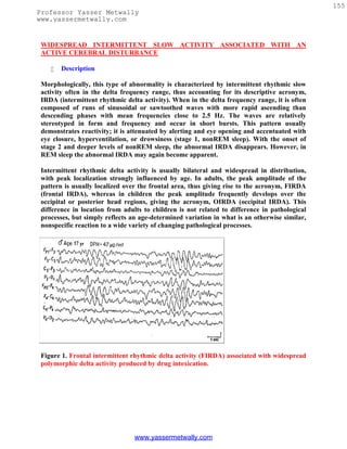 155
Professor Yasser Metwally
www.yassermetwally.com


 WIDESPREAD INTERMITTENT SLOW ACTIVITY ASSOCIATED WITH AN
 ACTIVE CEREBRAL DISTURBANCE

       Description

 Morphologically, this type of abnormality is characterized by intermittent rhythmic slow
 activity often in the delta frequency range, thus accounting for its descriptive acronym,
 IRDA (intermittent rhythmic delta activity). When in the delta frequency range, it is often
 composed of runs of sinusoidal or sawtoothed waves with more rapid ascending than
 descending phases with mean frequencies close to 2.5 Hz. The waves are relatively
 stereotyped in form and frequency and occur in short bursts. This pattern usually
 demonstrates reactivity; it is attenuated by alerting and eye opening and accentuated with
 eye closure, hyperventilation, or drowsiness (stage 1, nonREM sleep). With the onset of
 stage 2 and deeper levels of nonREM sleep, the abnormal IRDA disappears. However, in
 REM sleep the abnormal IRDA may again become apparent.

 Intermittent rhythmic delta activity is usually bilateral and widespread in distribution,
 with peak localization strongly influenced by age. In adults, the peak amplitude of the
 pattern is usually localized over the frontal area, thus giving rise to the acronym, FIRDA
 (frontal IRDA), whereas in children the peak amplitude frequently develops over the
 occipital or posterior head regions, giving the acronym, OIRDA (occipital IRDA). This
 difference in location from adults to children is not related to difference in pathological
 processes, but simply reflects an age-determined variation in what is an otherwise similar,
 nonspecific reaction to a wide variety of changing pathological processes.




 Figure 1. Frontal intermittent rhythmic delta activity (FIRDA) associated with widespread
 polymorphic delta activity produced by drug intoxication.




                                 www.yassermetwally.com
 