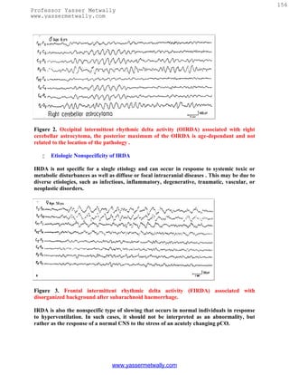 156
Professor Yasser Metwally
www.yassermetwally.com




 Figure 2. Occipital intermittent rhythmic delta activity (OIRDA) associated with right
 cerebellar astrocytoma, the posterior maximum of the OIRDA is age-dependant and not
 related to the location of the pathology .

       Etiologic Nonspecificity of IRDA

 IRDA is not specific for a single etiology and can occur in response to systemic toxic or
 metabolic disturbances as well as diffuse or focal intracranial diseases . This may be due to
 diverse etiologies, such as infectious, inflammatory, degenerative, traumatic, vascular, or
 neoplastic disorders.




 Figure 3. Frontal intermittent rhythmic delta activity (FIRDA) associated with
 disorganized background after subarachnoid haemorrhage.

 IRDA is also the nonspecific type of slowing that occurs in normal individuals in response
 to hyperventilation. In such cases, it should not be interpreted as an abnormality, but
 rather as the response of a normal CNS to the stress of an acutely changing pCO.




                                 www.yassermetwally.com
 